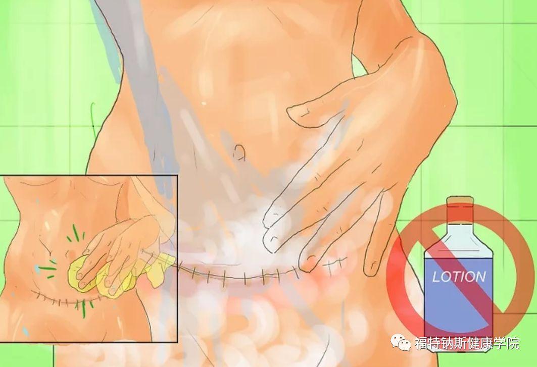 【产后康复】给剖腹产妈妈的康复建议，请查收！